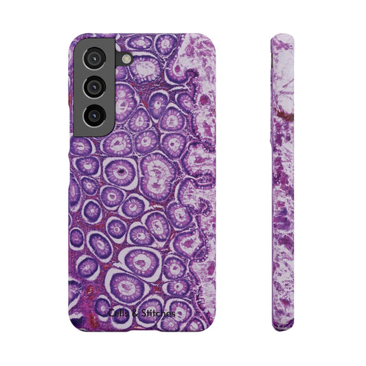 Slim Case Peutz-Jeghers Polyp