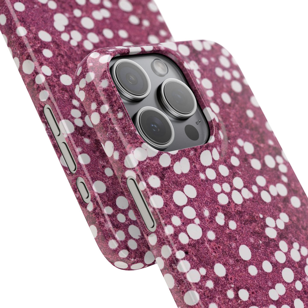 Slim Case Myelolipom