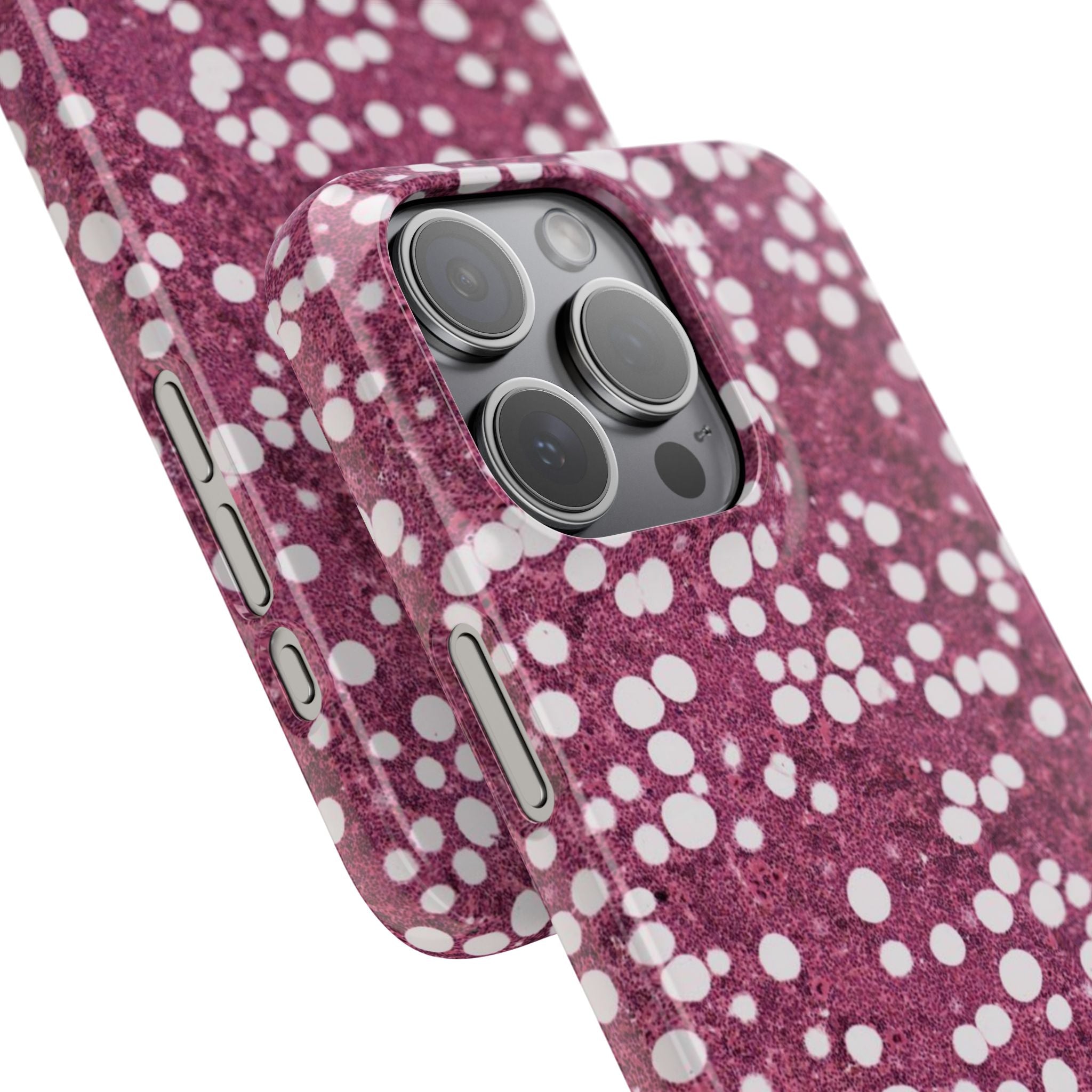 Slim Case Myelolipom