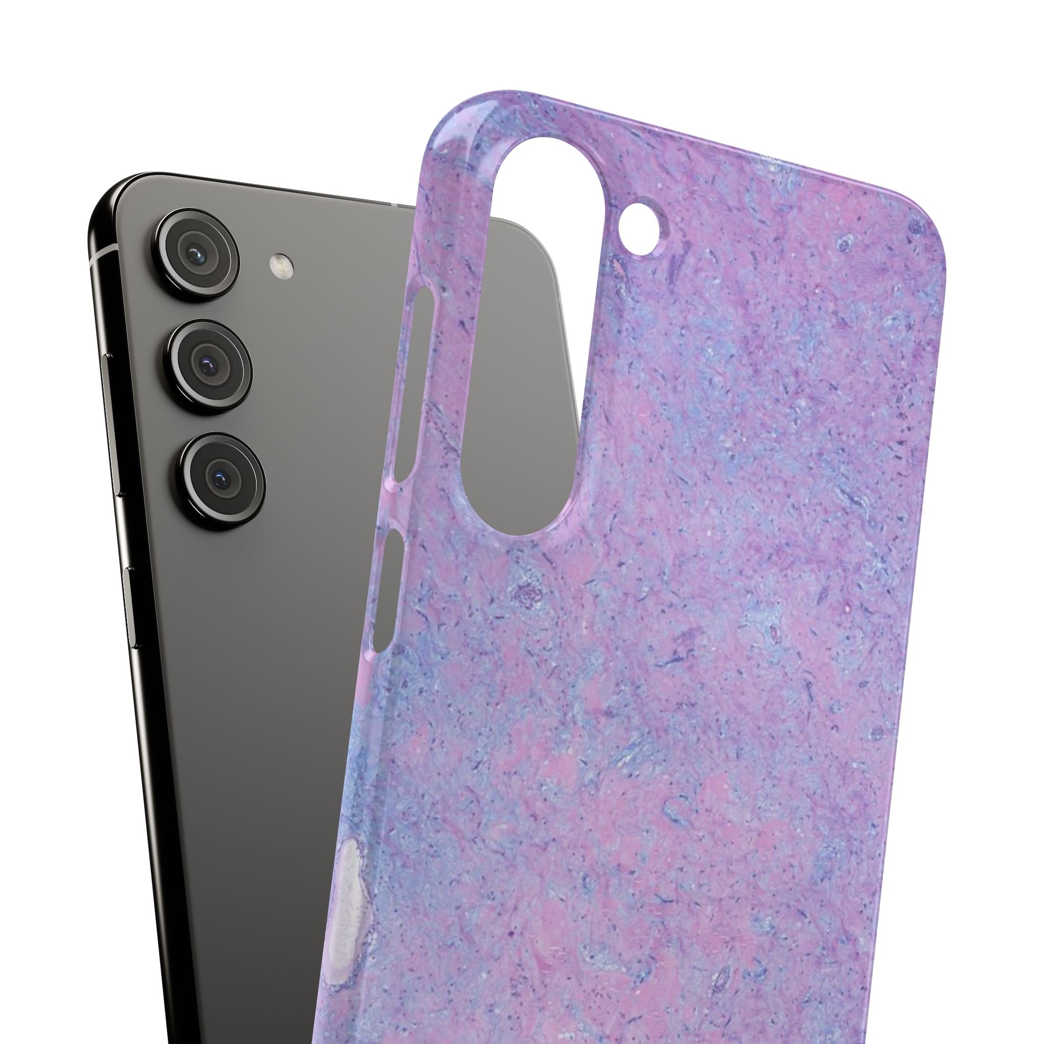 Slim Case Arterielles Myxom