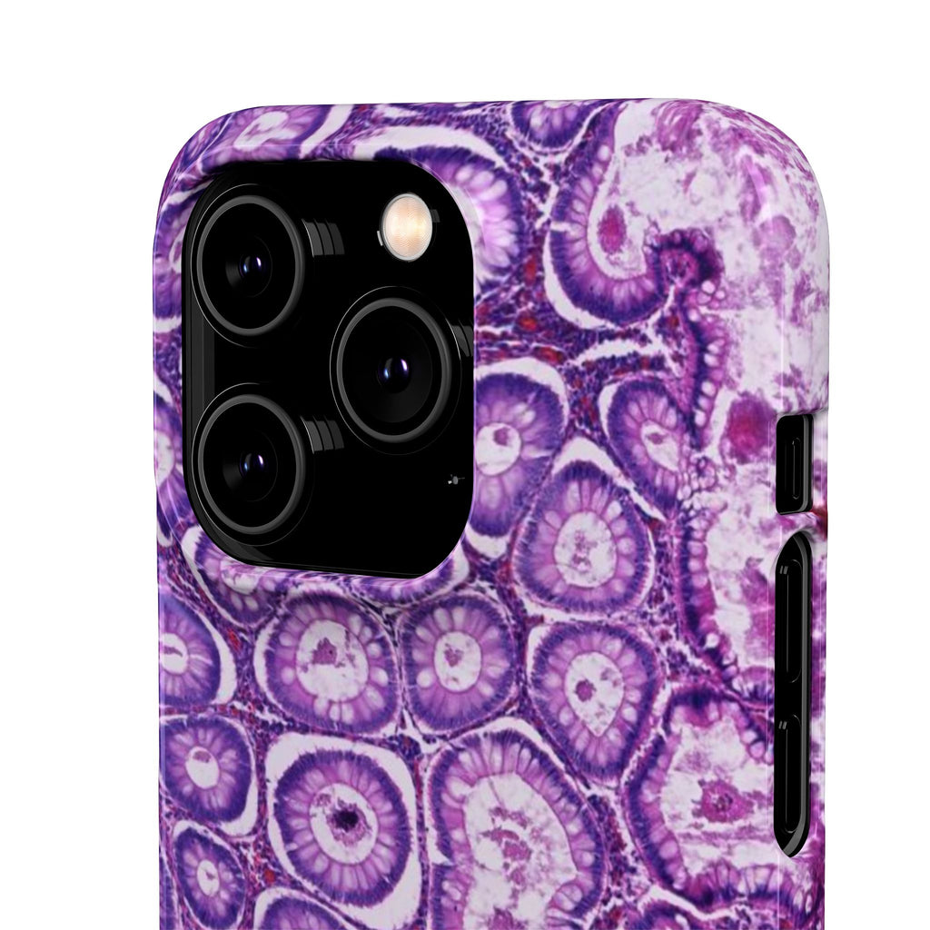 Slim Case Peutz-Jeghers Polyp