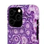 Slim Case Peutz-Jeghers Polyp