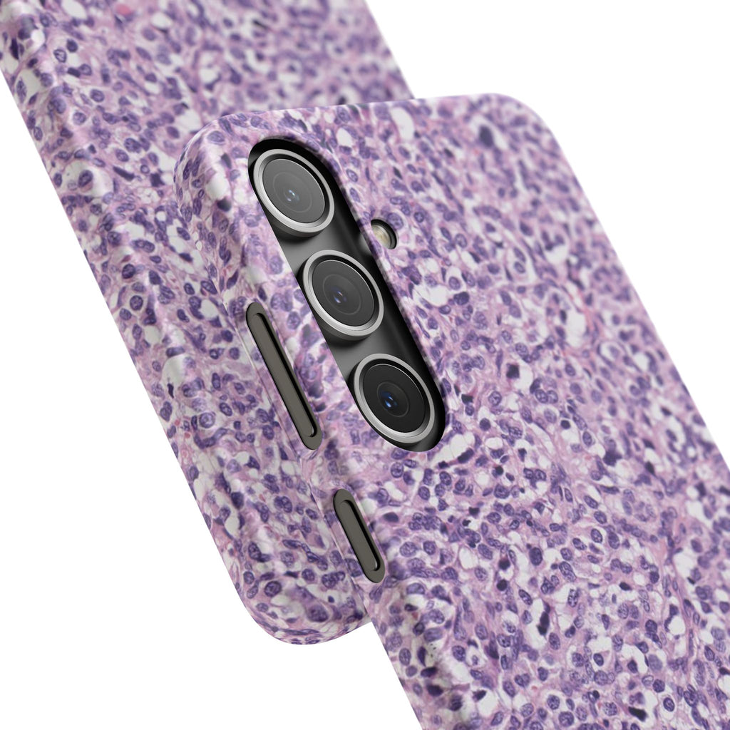 Slim Case Paraganglion