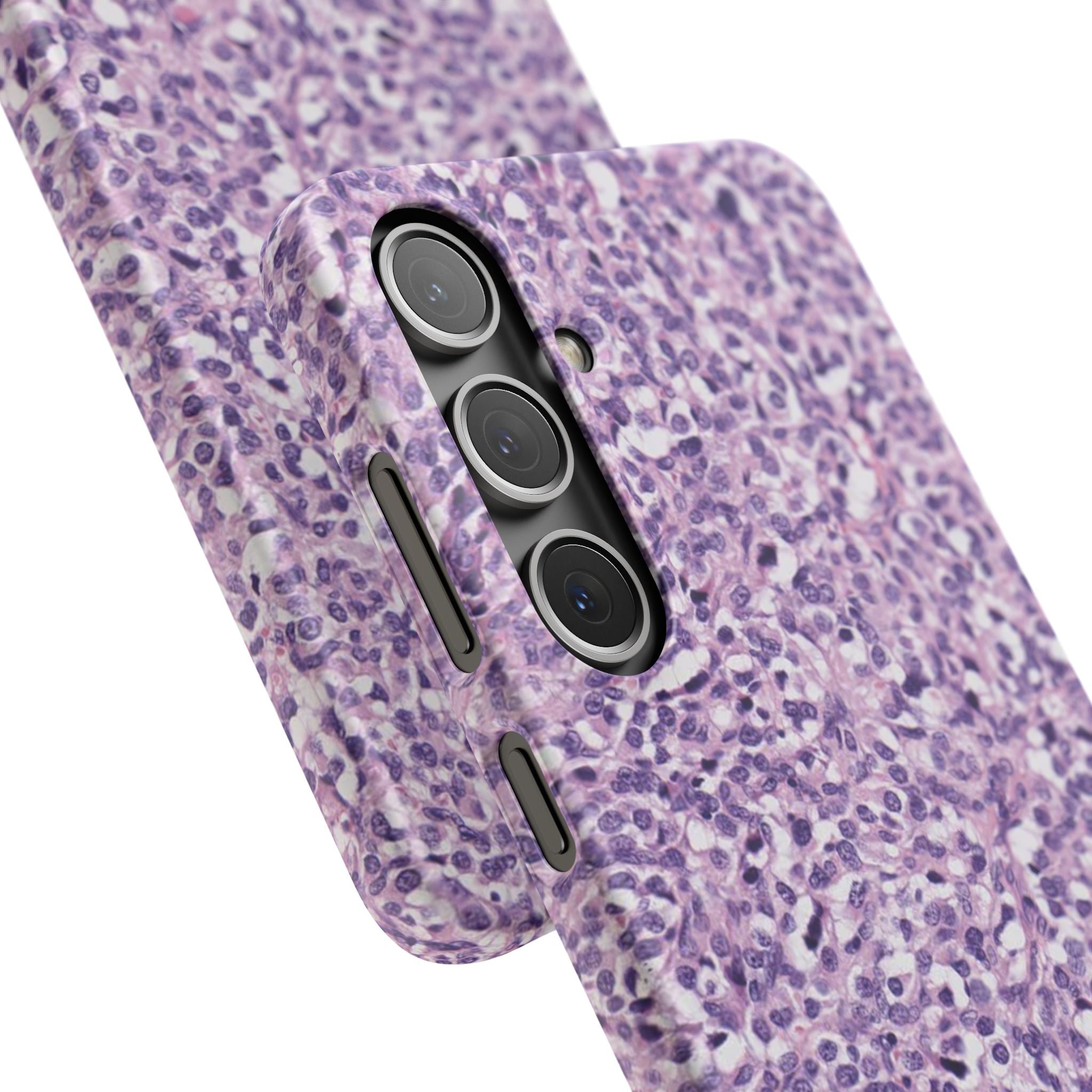Slim Case Paraganglion