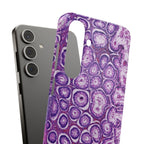 Slim Case Peutz-Jeghers Polyp
