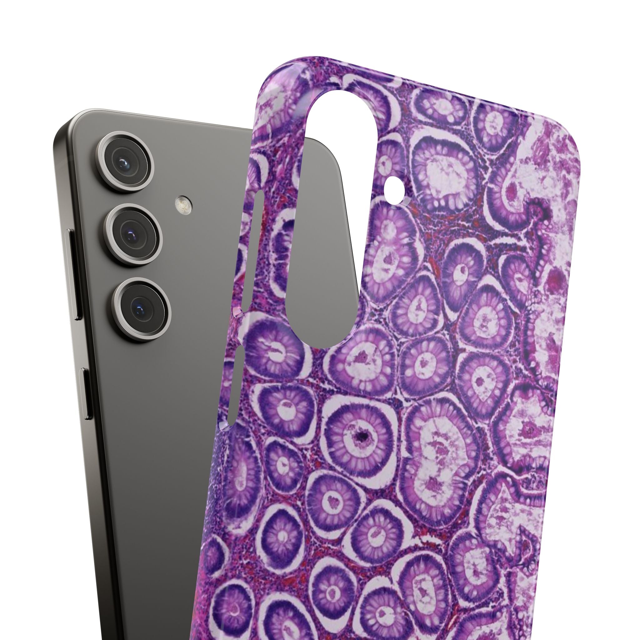 Slim Case Peutz-Jeghers Polyp