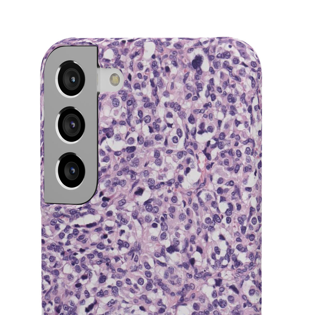 Slim Case Paraganglion