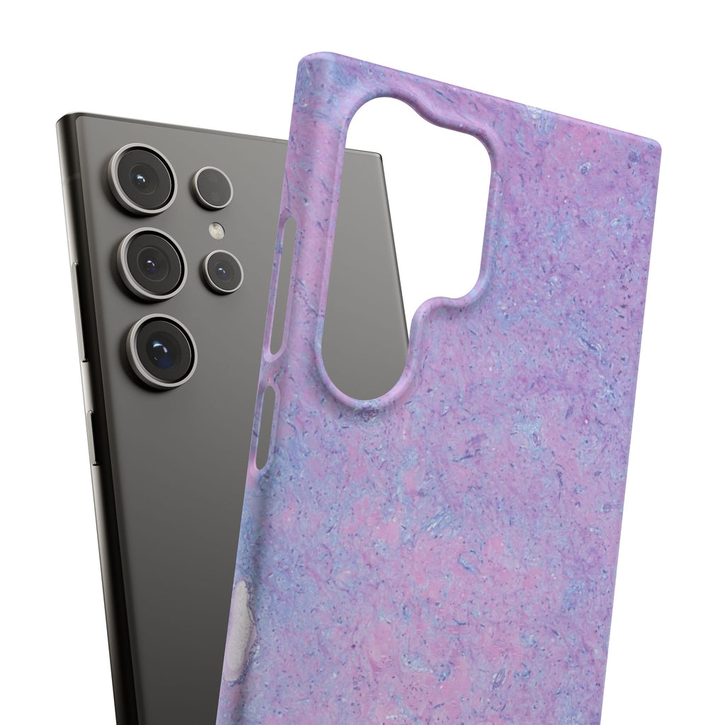 Slim Case Arterielles Myxom