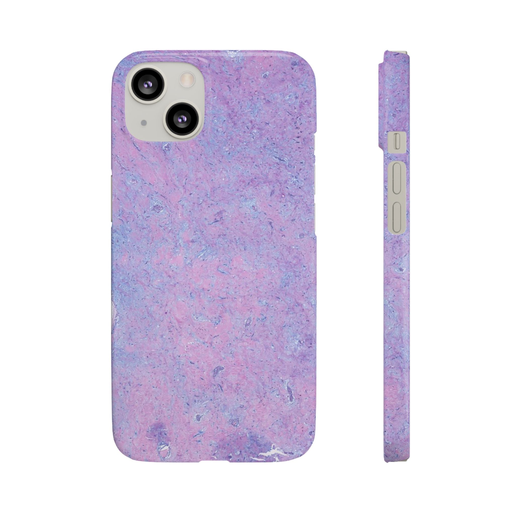 Slim Case Arterielles Myxom