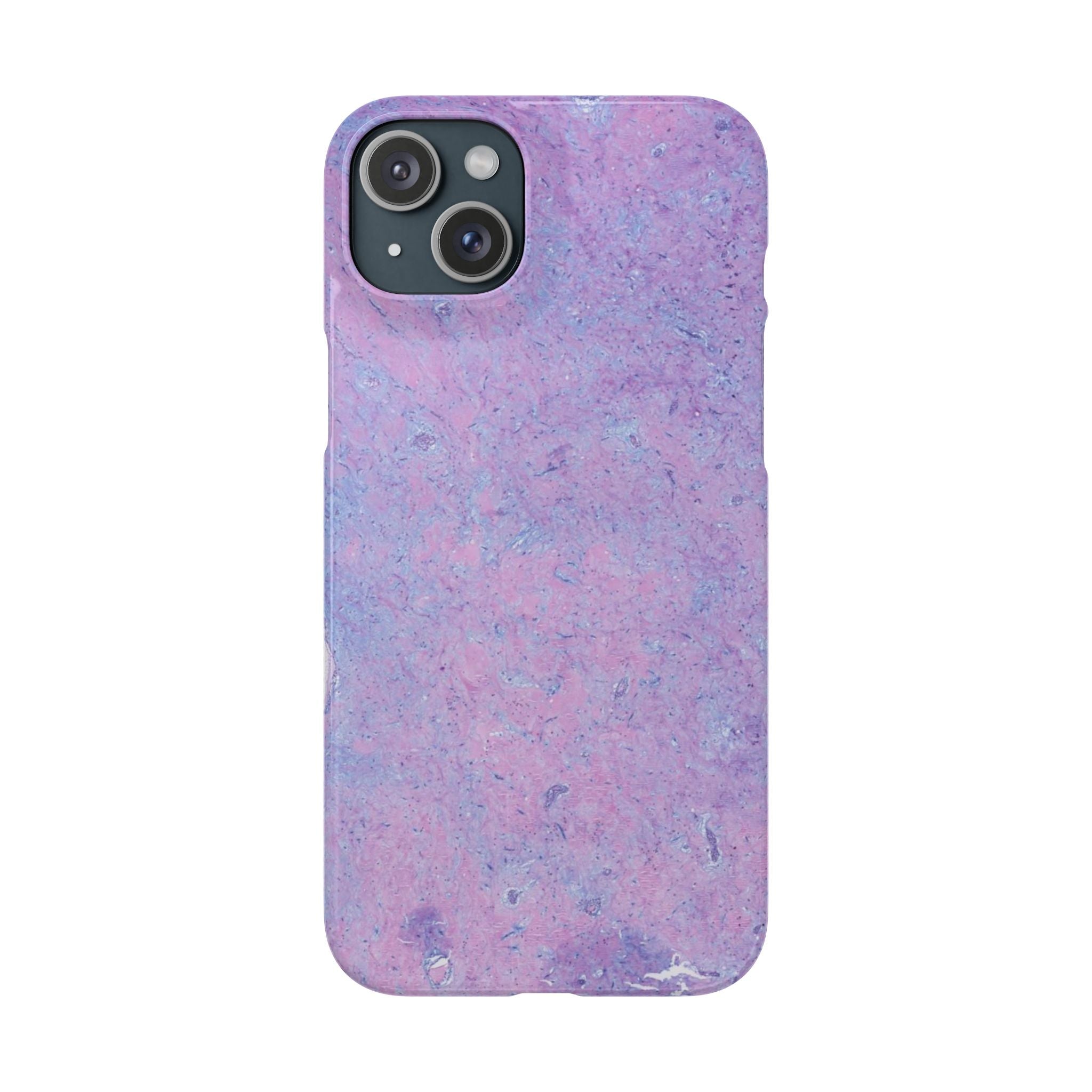 Slim Case Arterielles Myxom