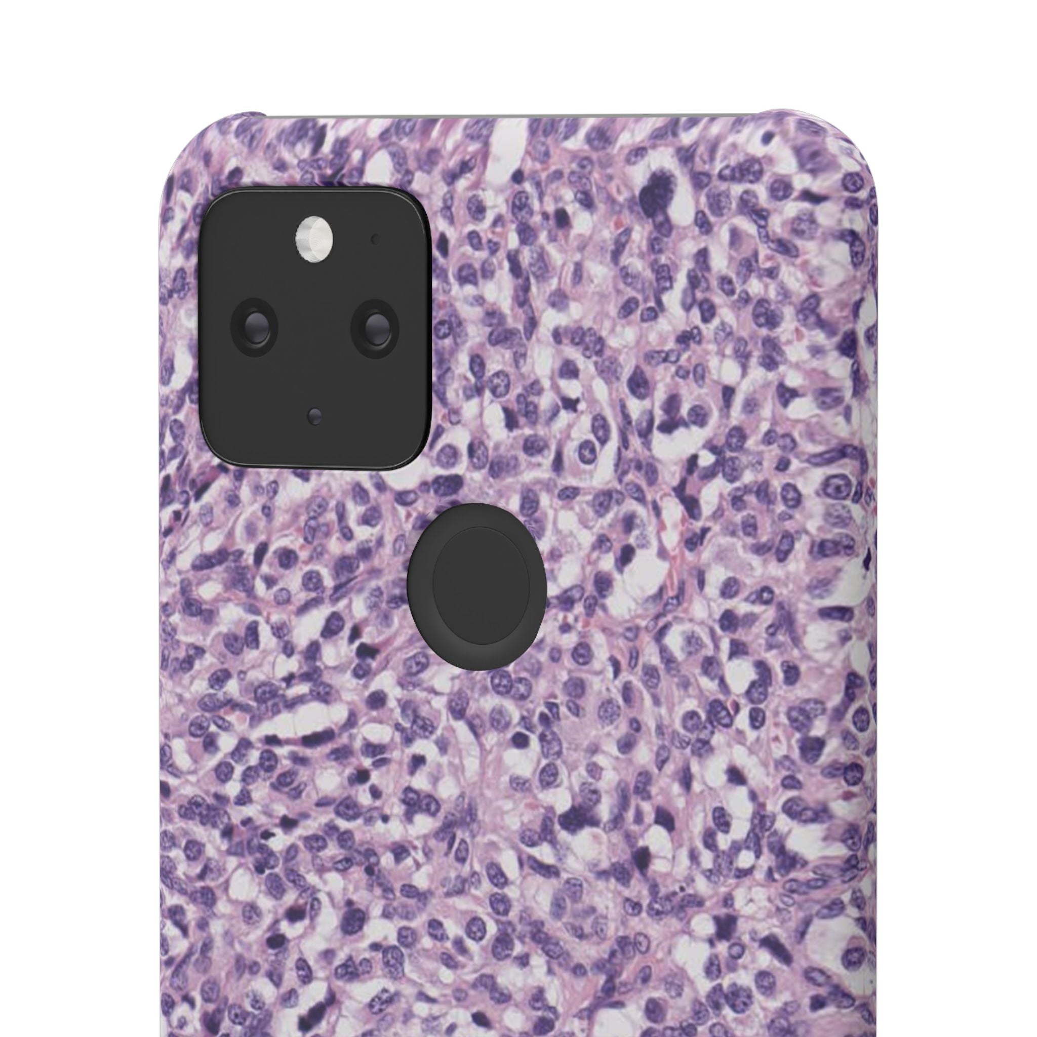 Slim Case Paraganglion