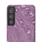 Slim Case Endometrium