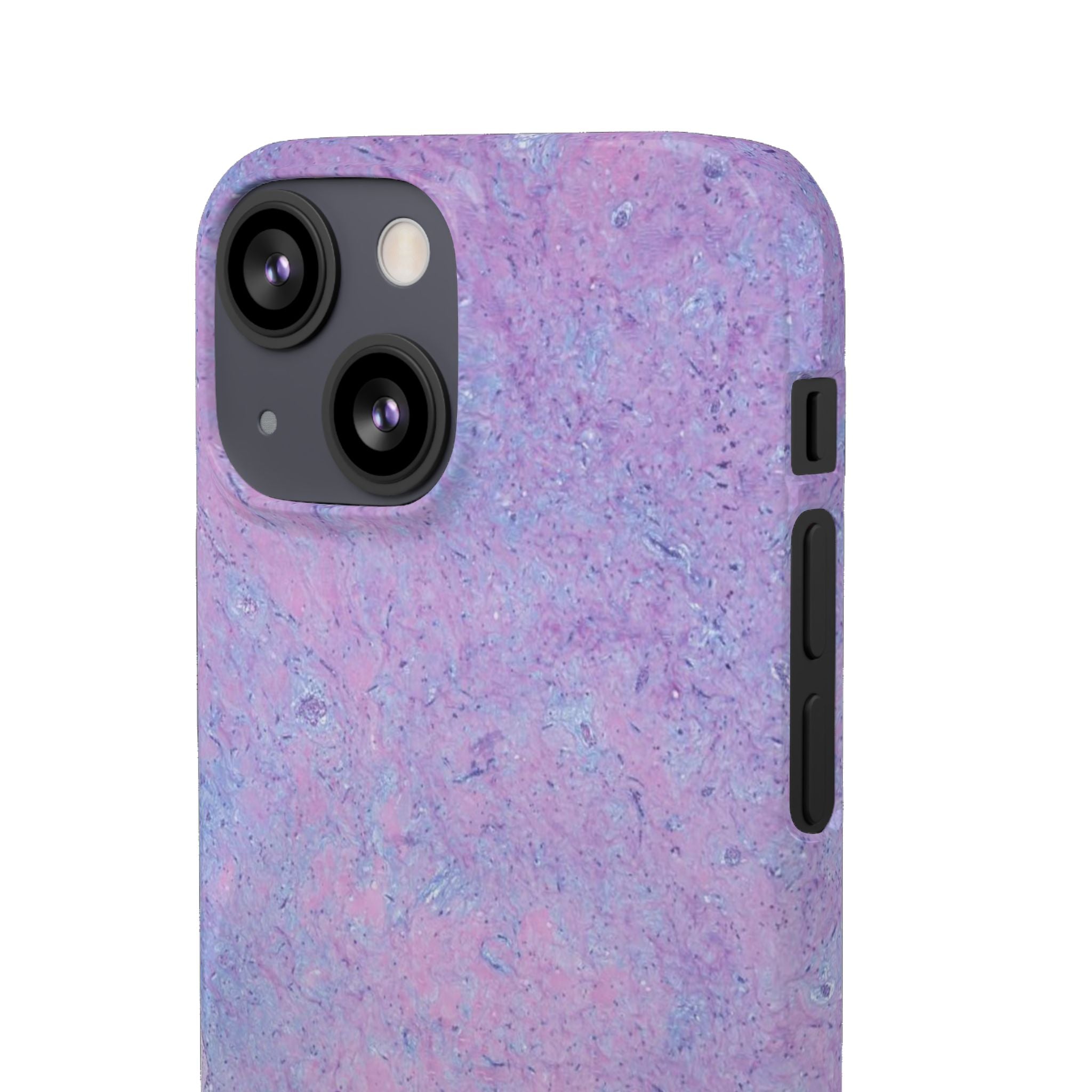Slim Case Arterielles Myxom