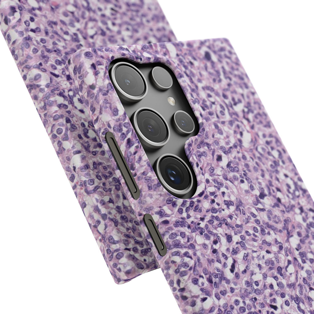 Slim Case Paraganglion