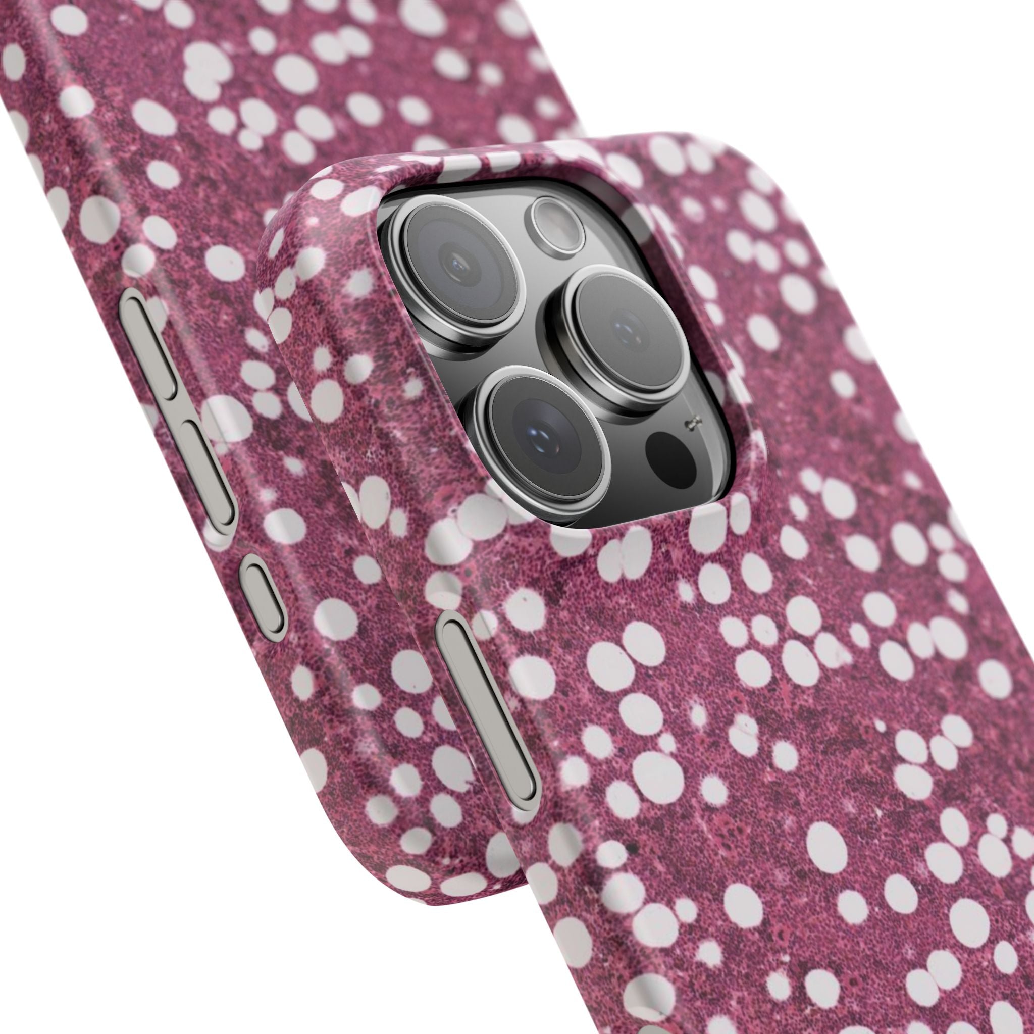 Slim Case Myelolipom