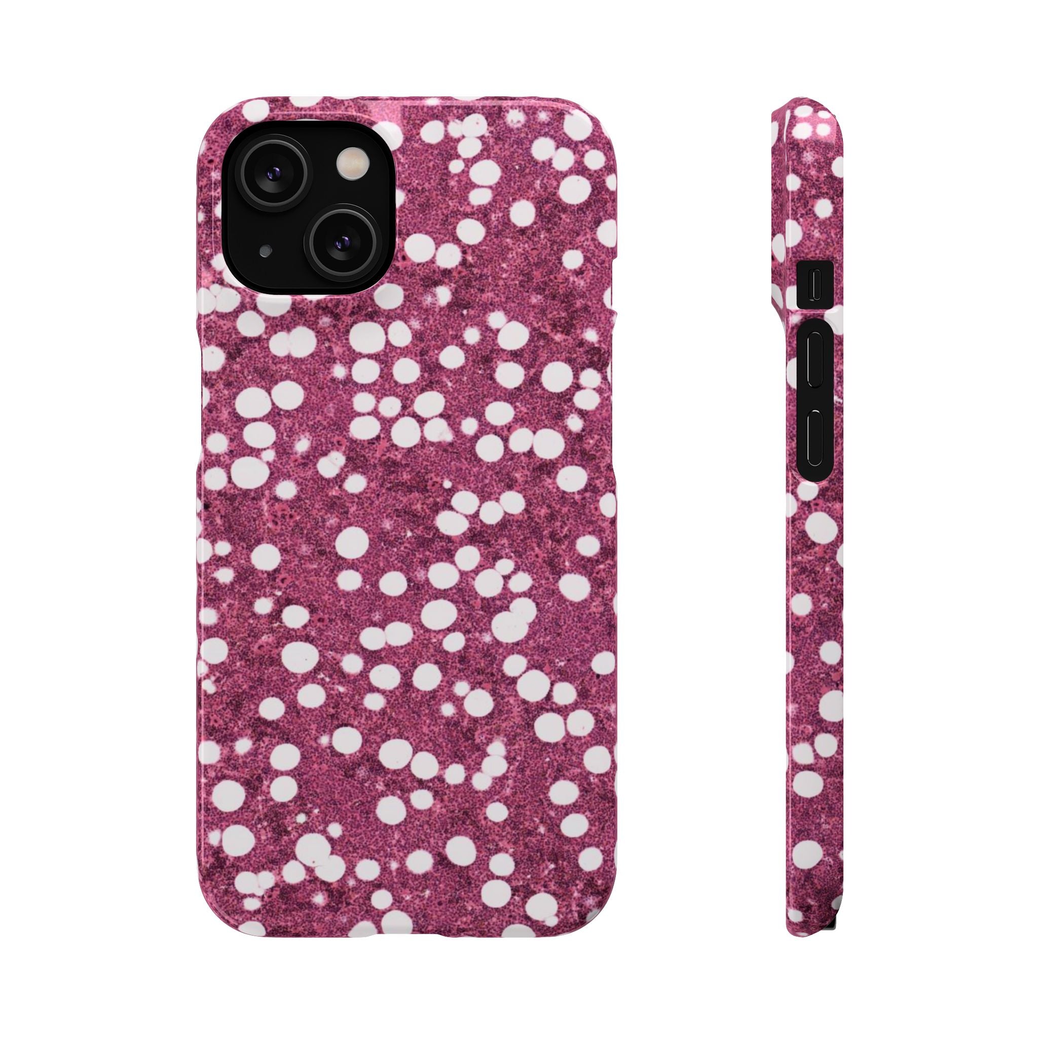 Slim Case Myelolipom