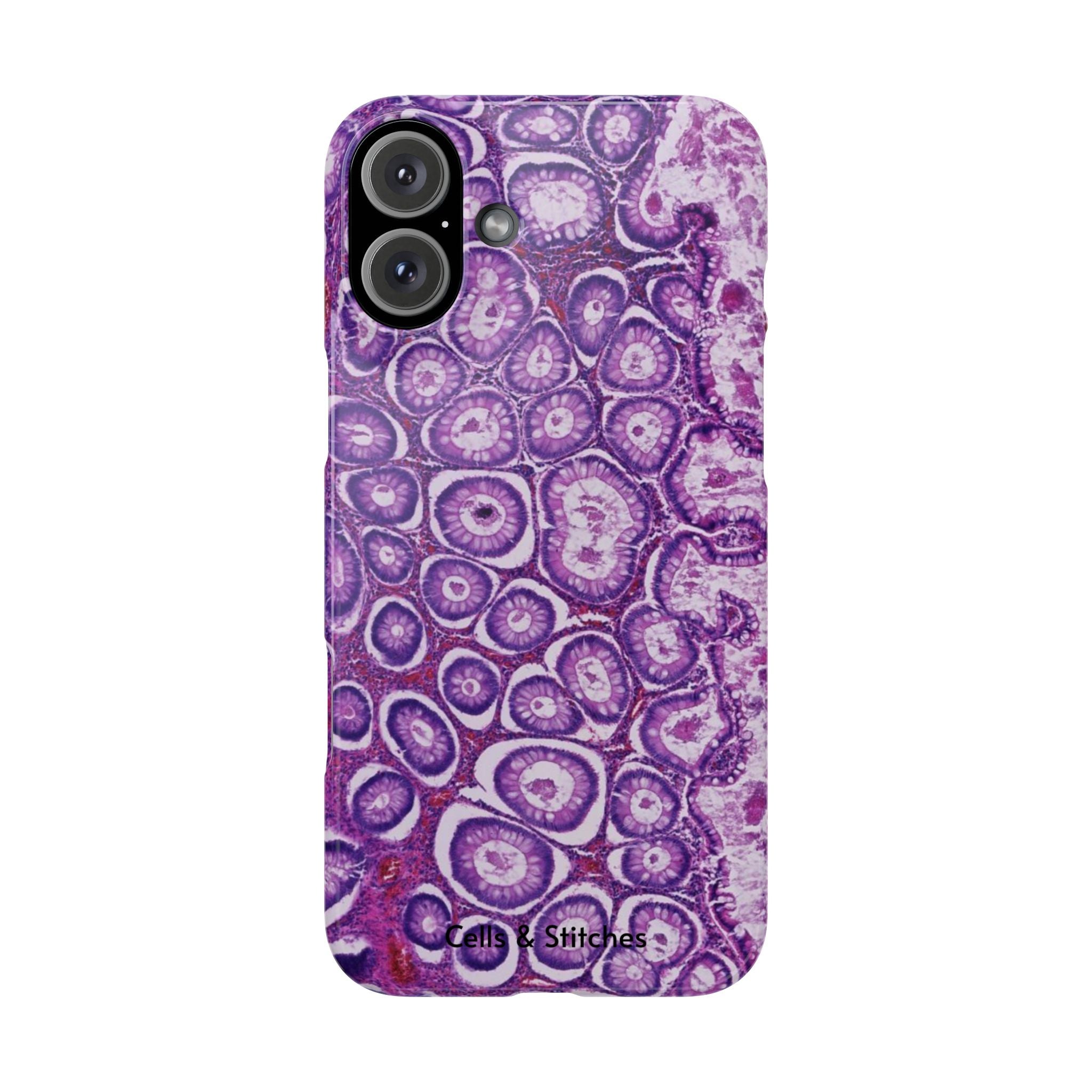 Slim Case Peutz-Jeghers Polyp