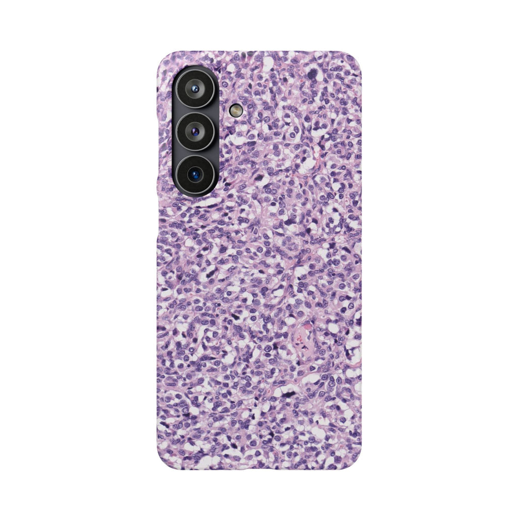 Slim Case Paraganglion