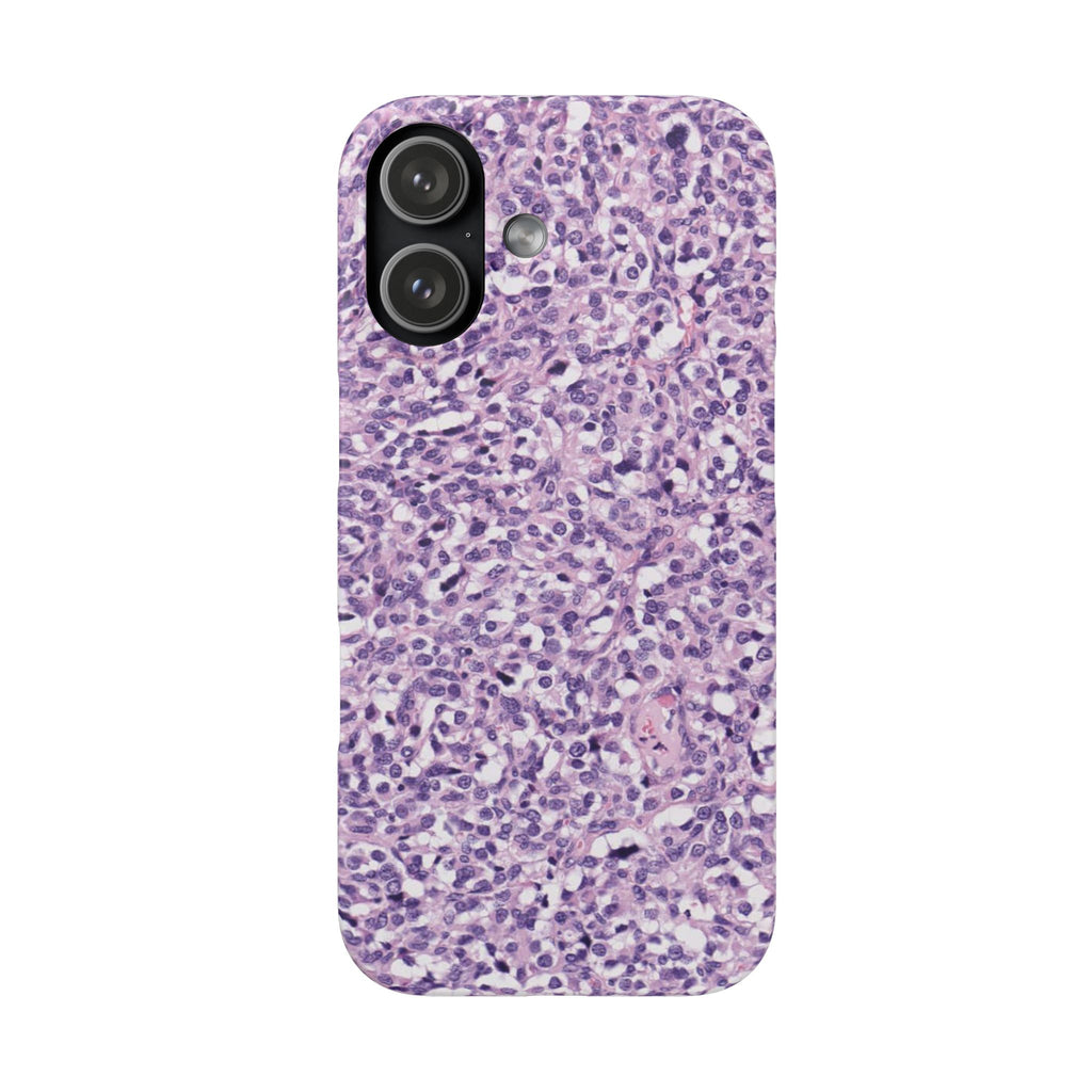 Slim Case Paraganglion