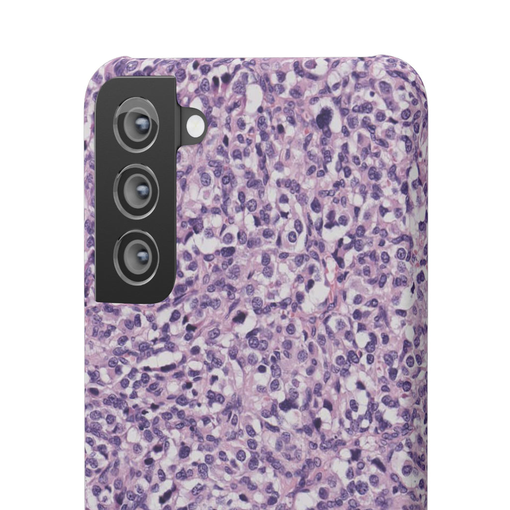 Slim Case Paraganglion