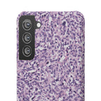 Slim Case Paraganglion