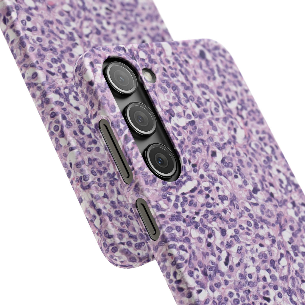 Slim Case Paraganglion