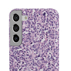 Slim Case Paraganglion