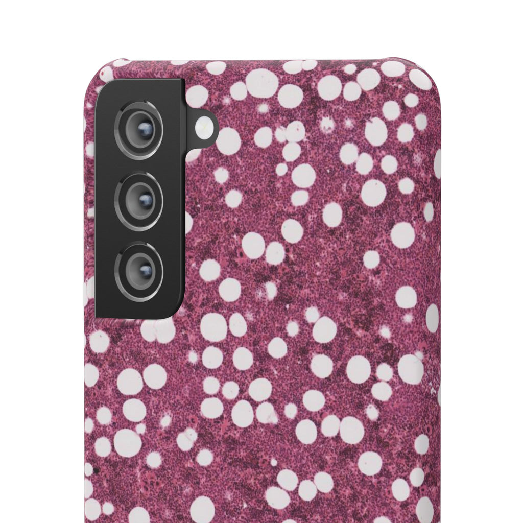 Slim Case Myelolipom
