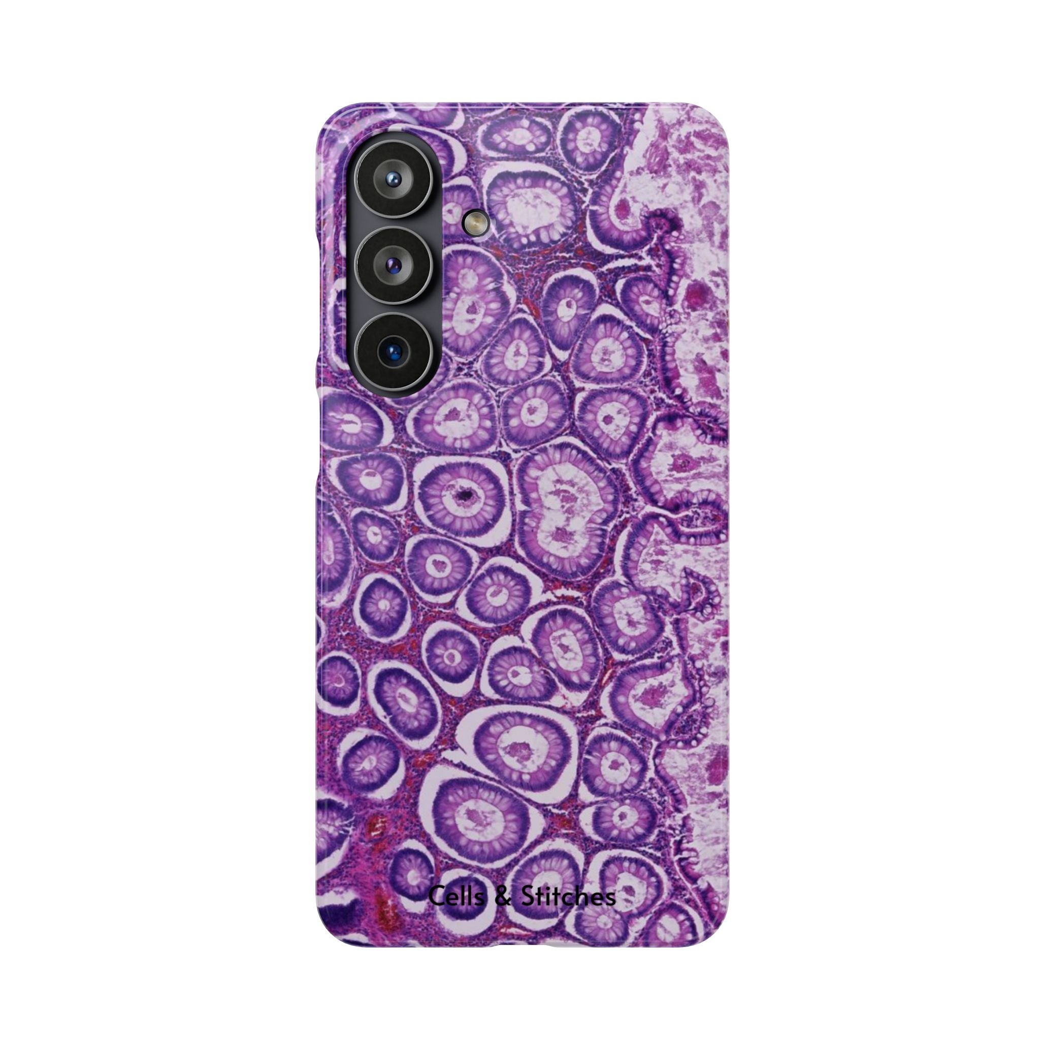Slim Case Peutz-Jeghers Polyp