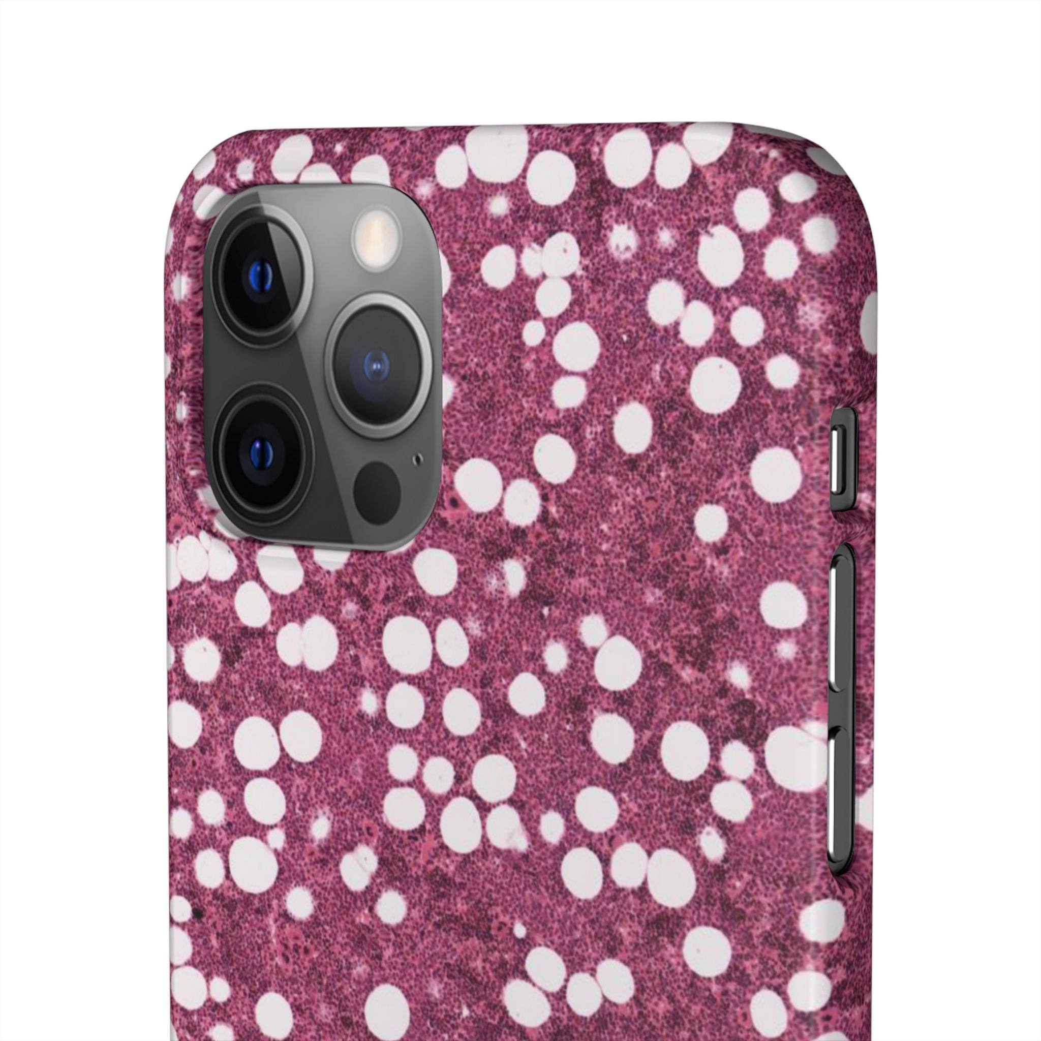 Slim Case Myelolipom