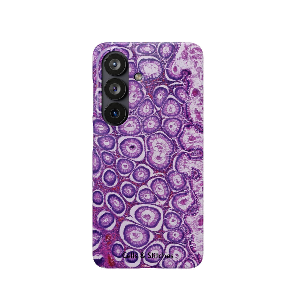 Slim Case Peutz-Jeghers Polyp
