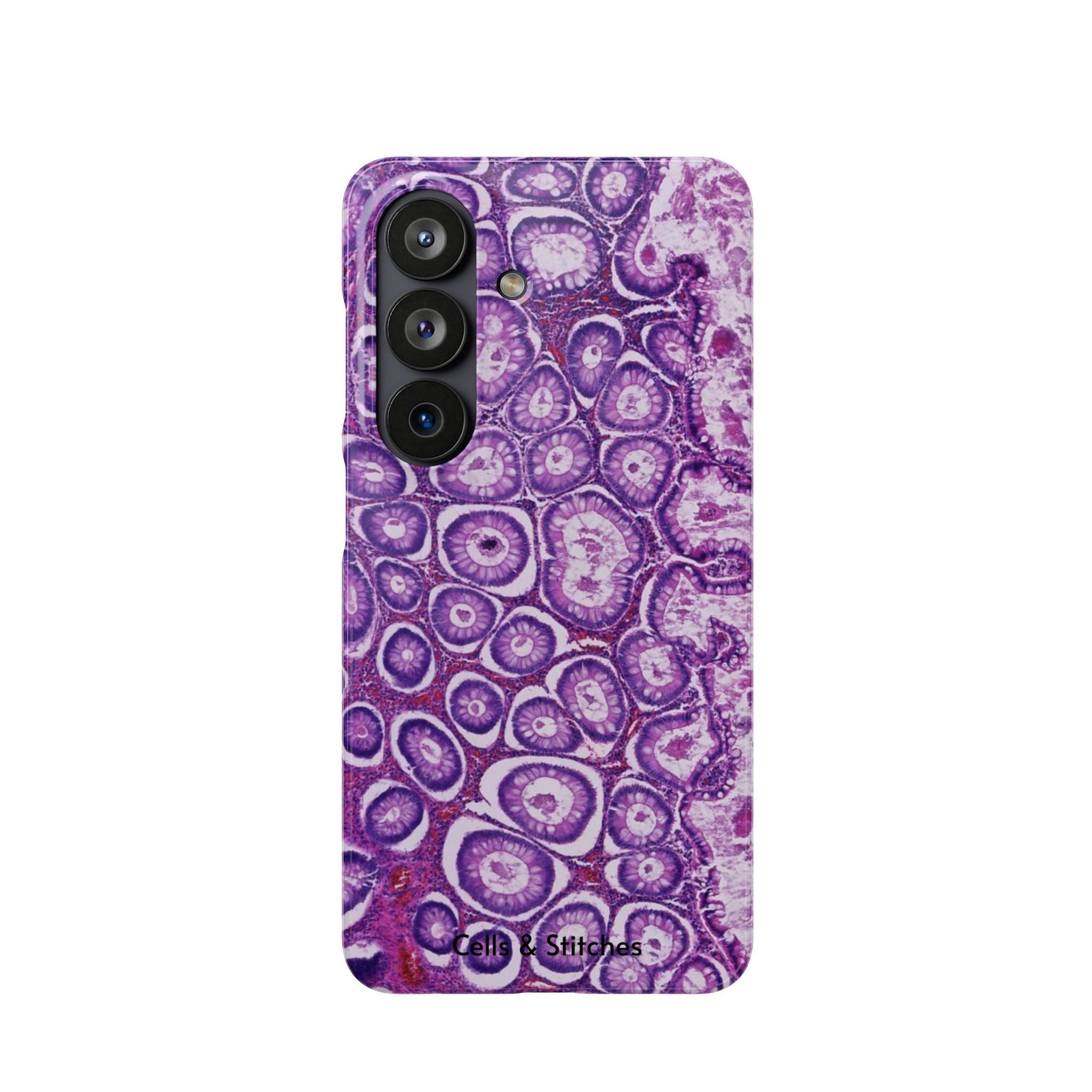 Slim Case Peutz-Jeghers Polyp