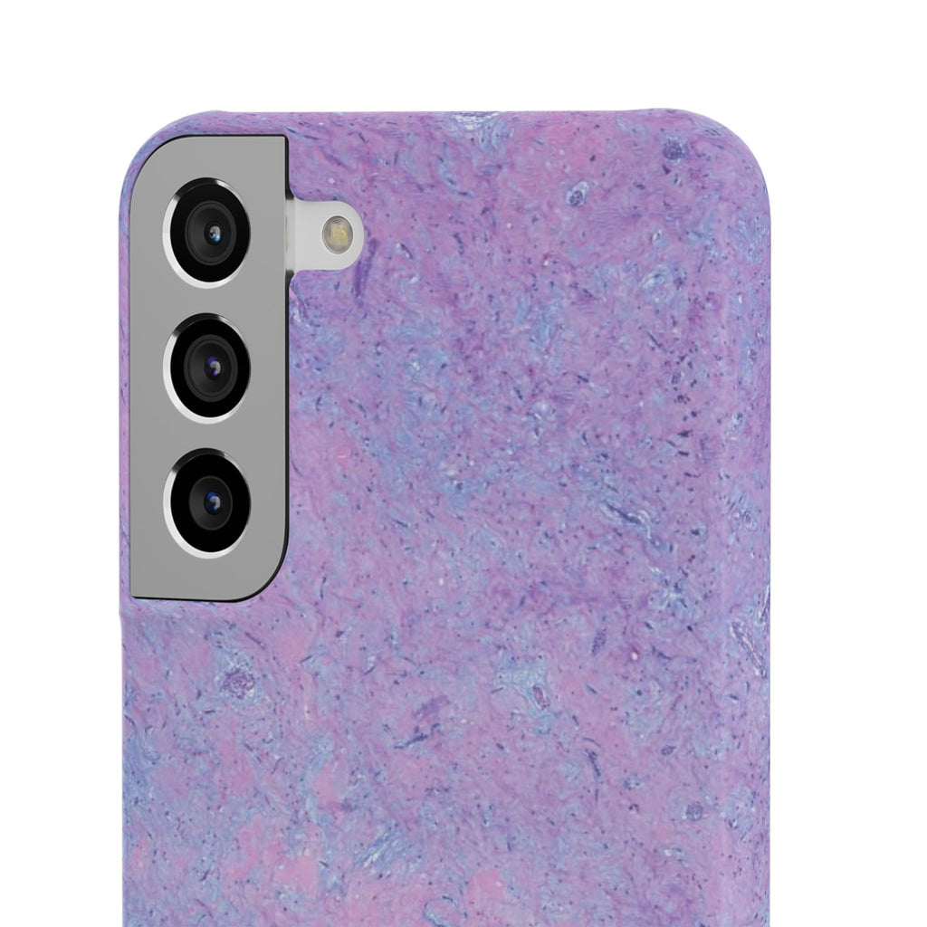 Slim Case Arterielles Myxom