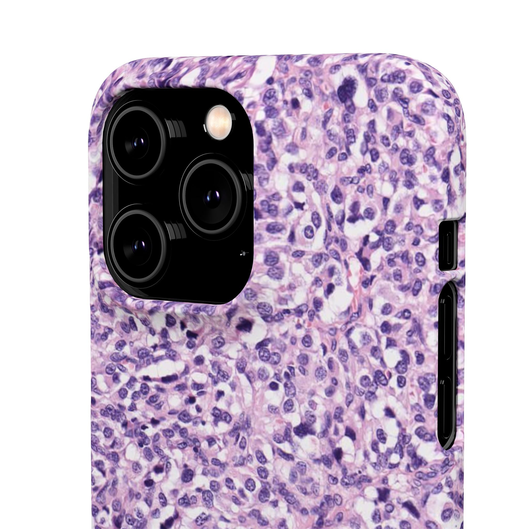 Slim Case Paraganglion