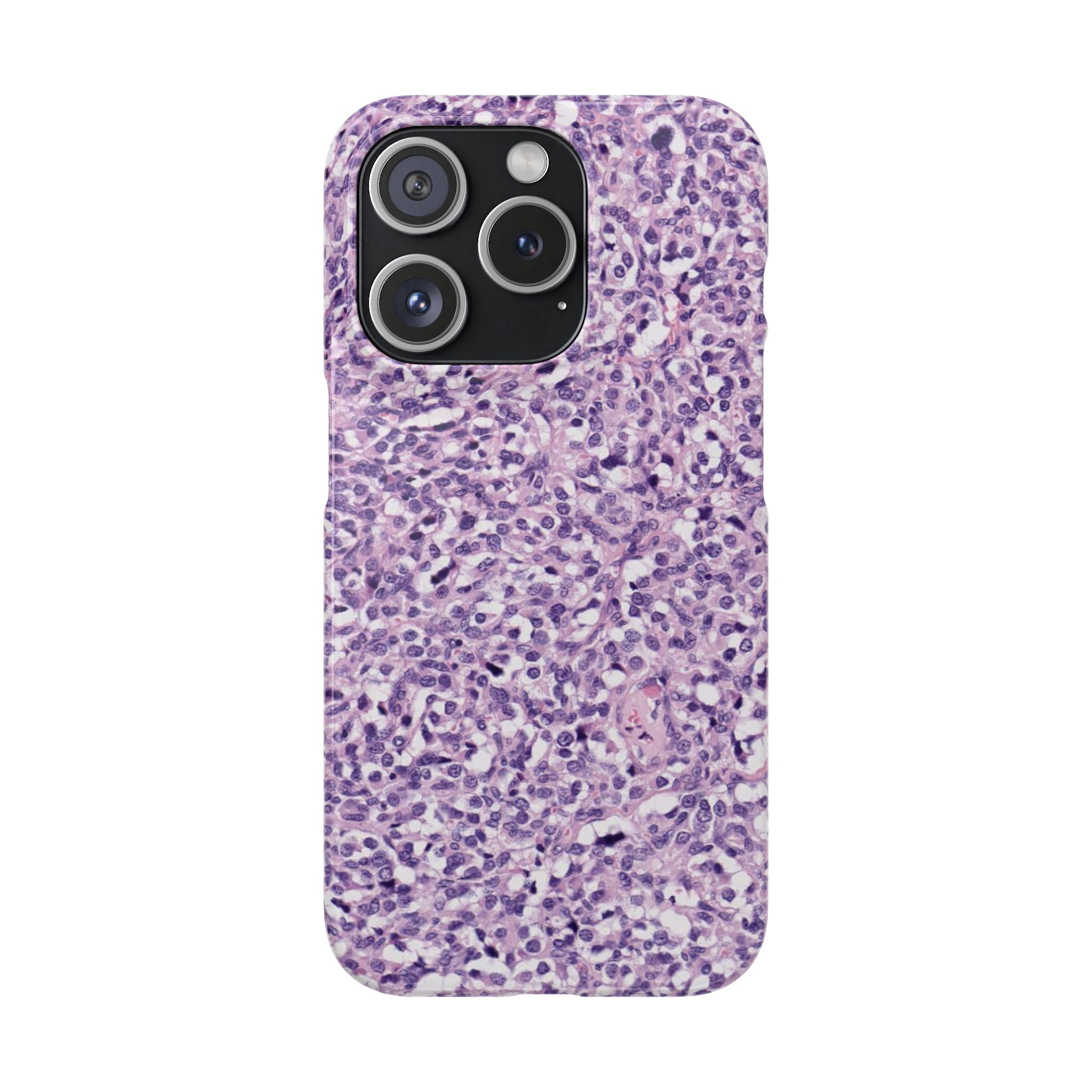 Slim Case Paraganglion