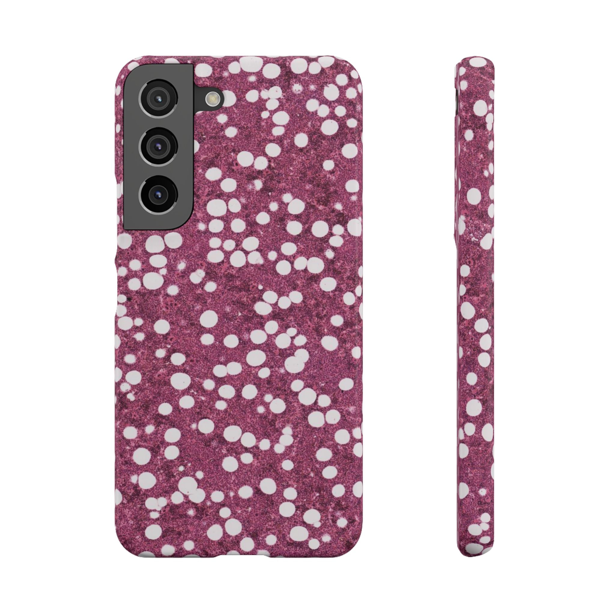 Slim Case Myelolipom