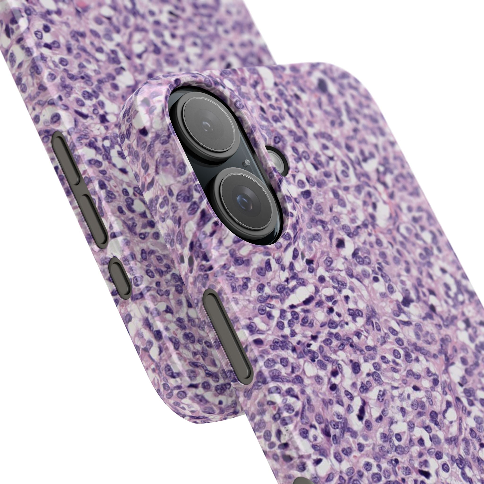 Slim Case Paraganglion