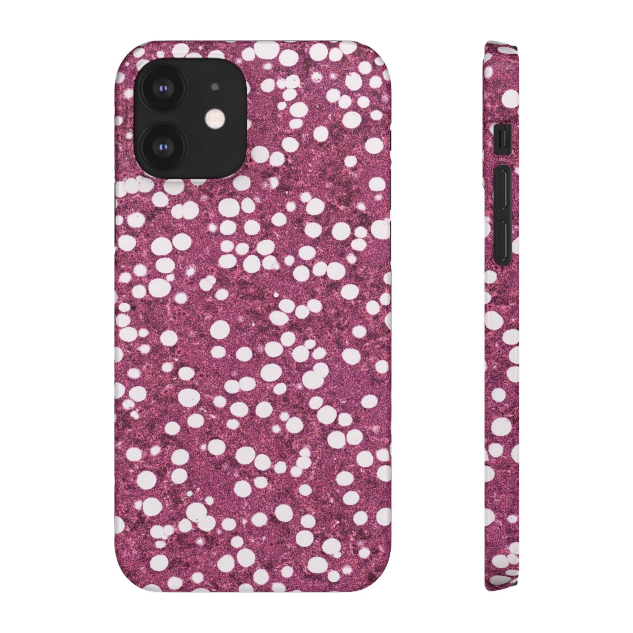 Slim Case Myelolipom