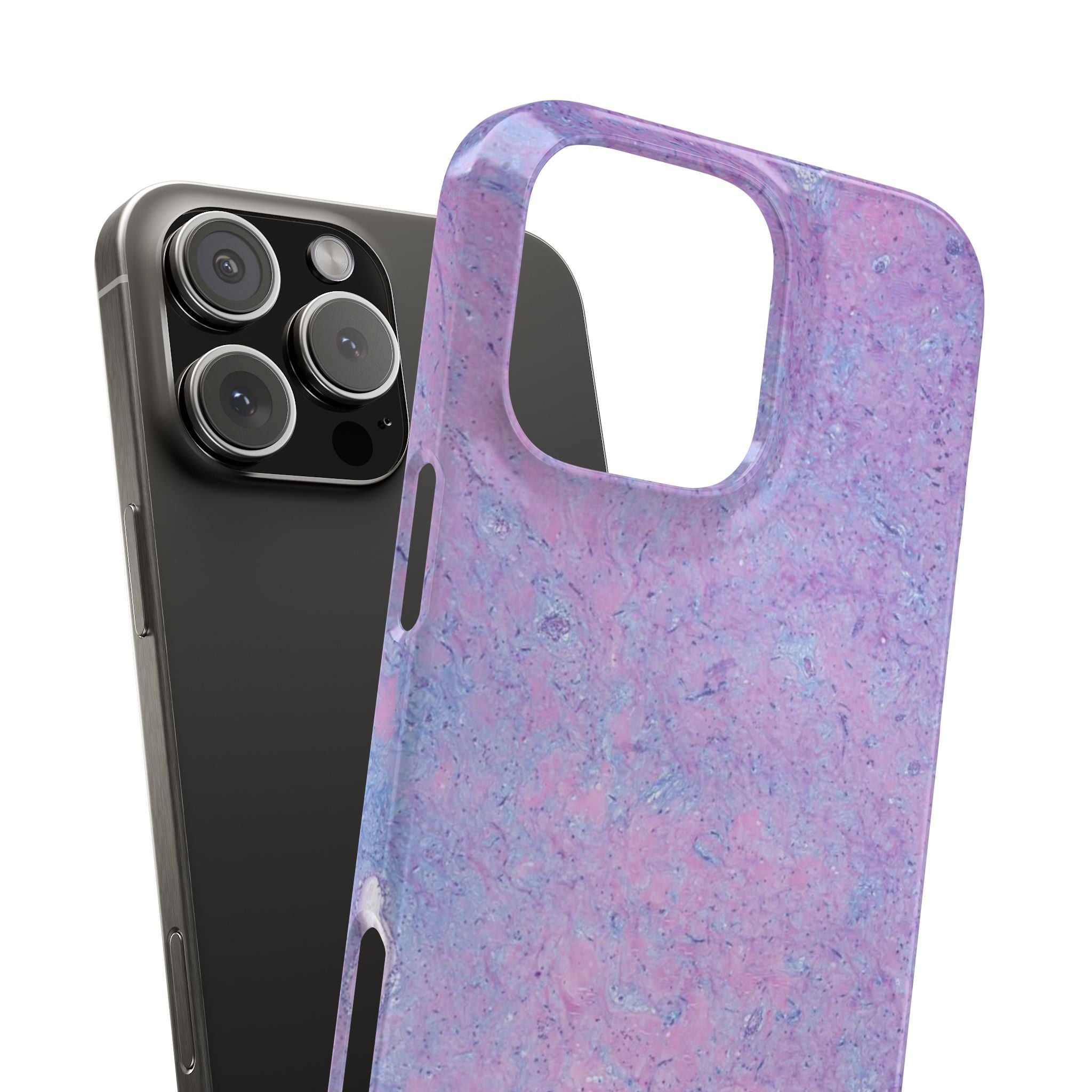 Slim Case Arterielles Myxom