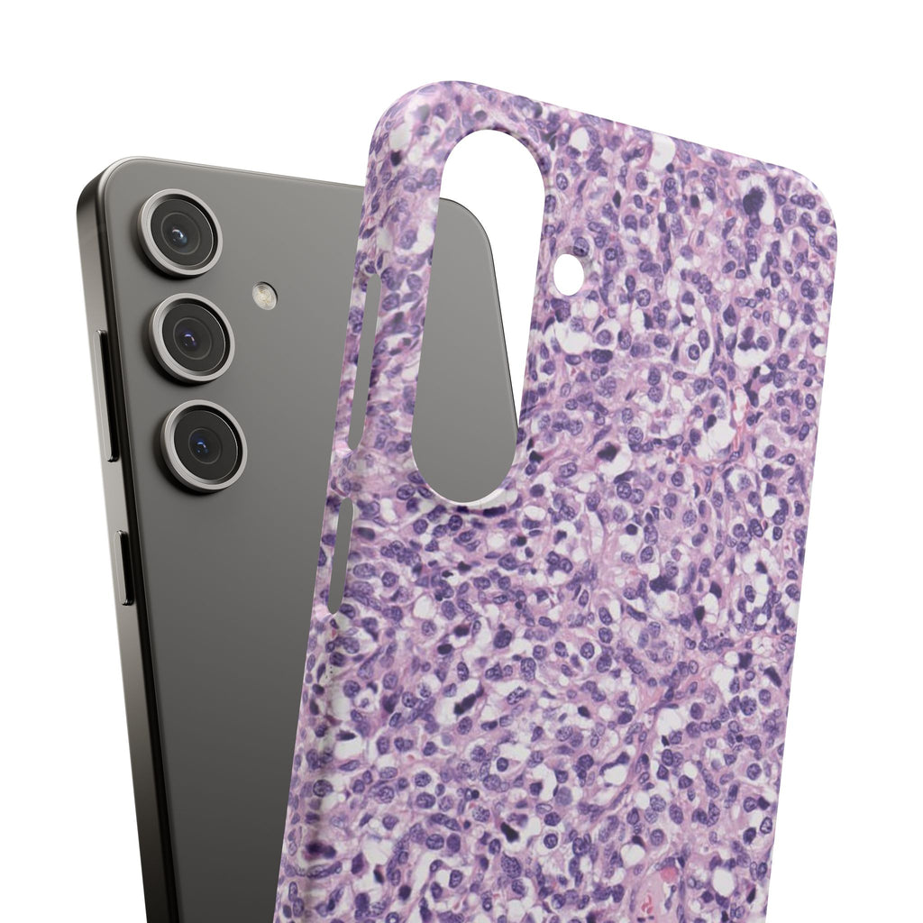 Slim Case Paraganglion