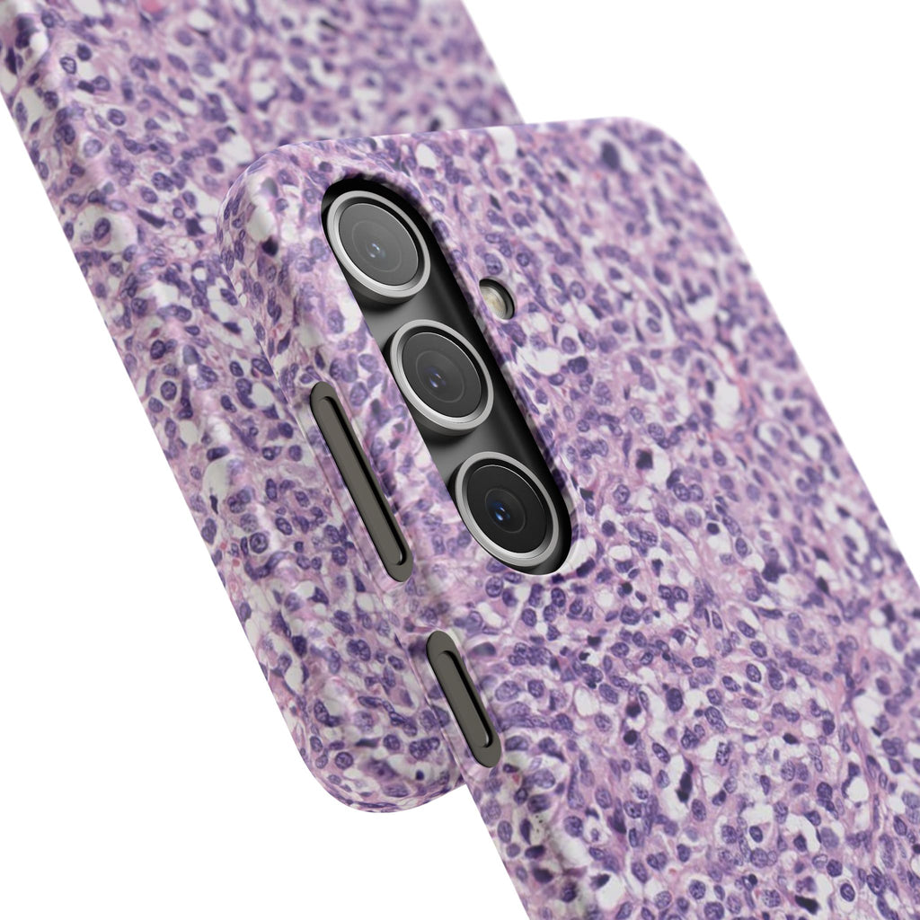 Slim Case Paraganglion