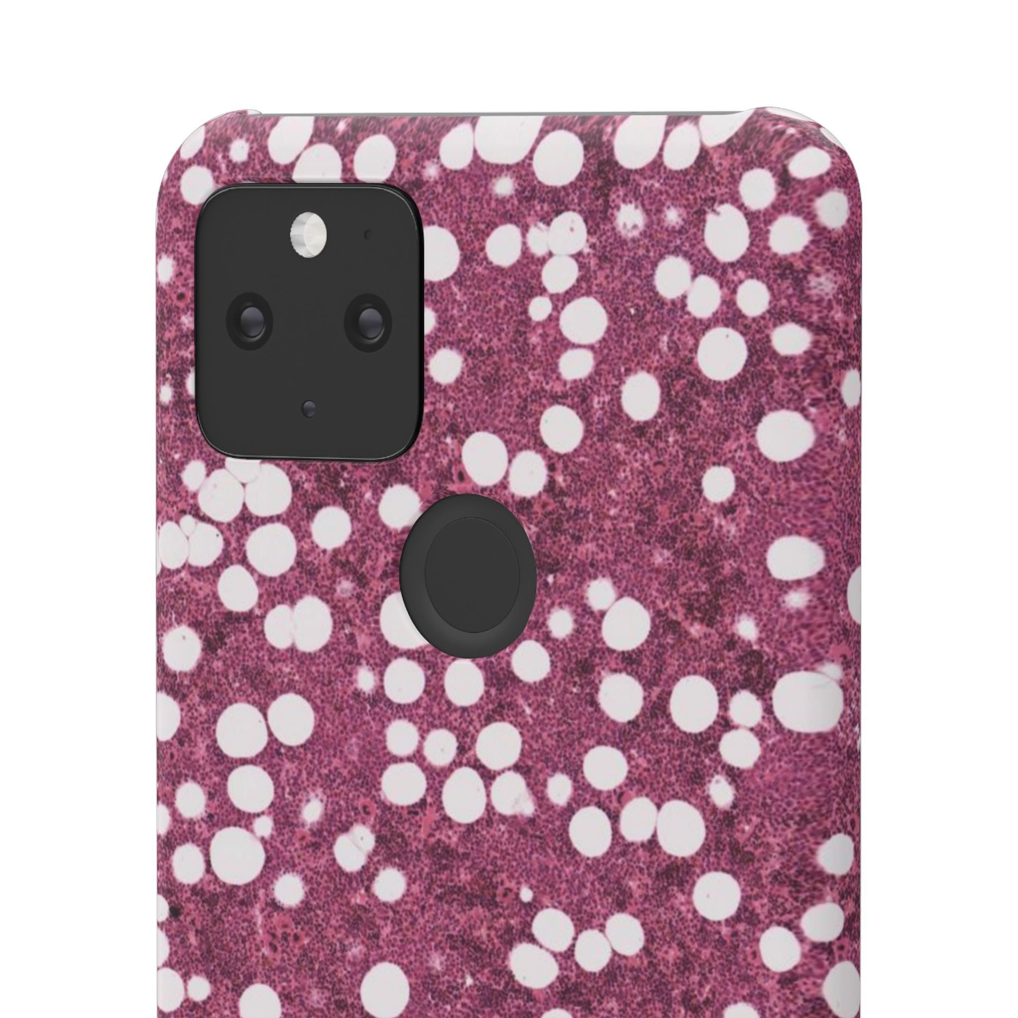 Slim Case Myelolipom