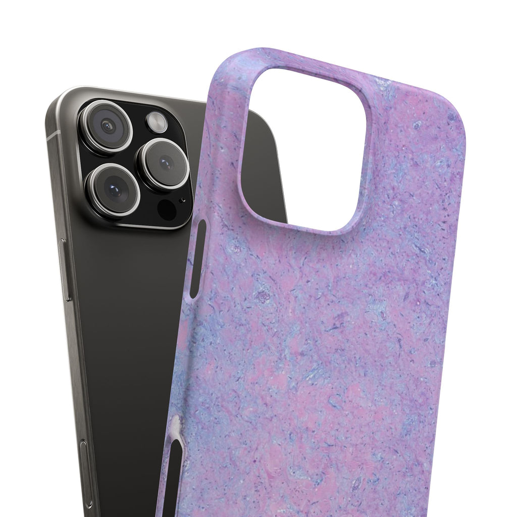 Slim Case Arterielles Myxom