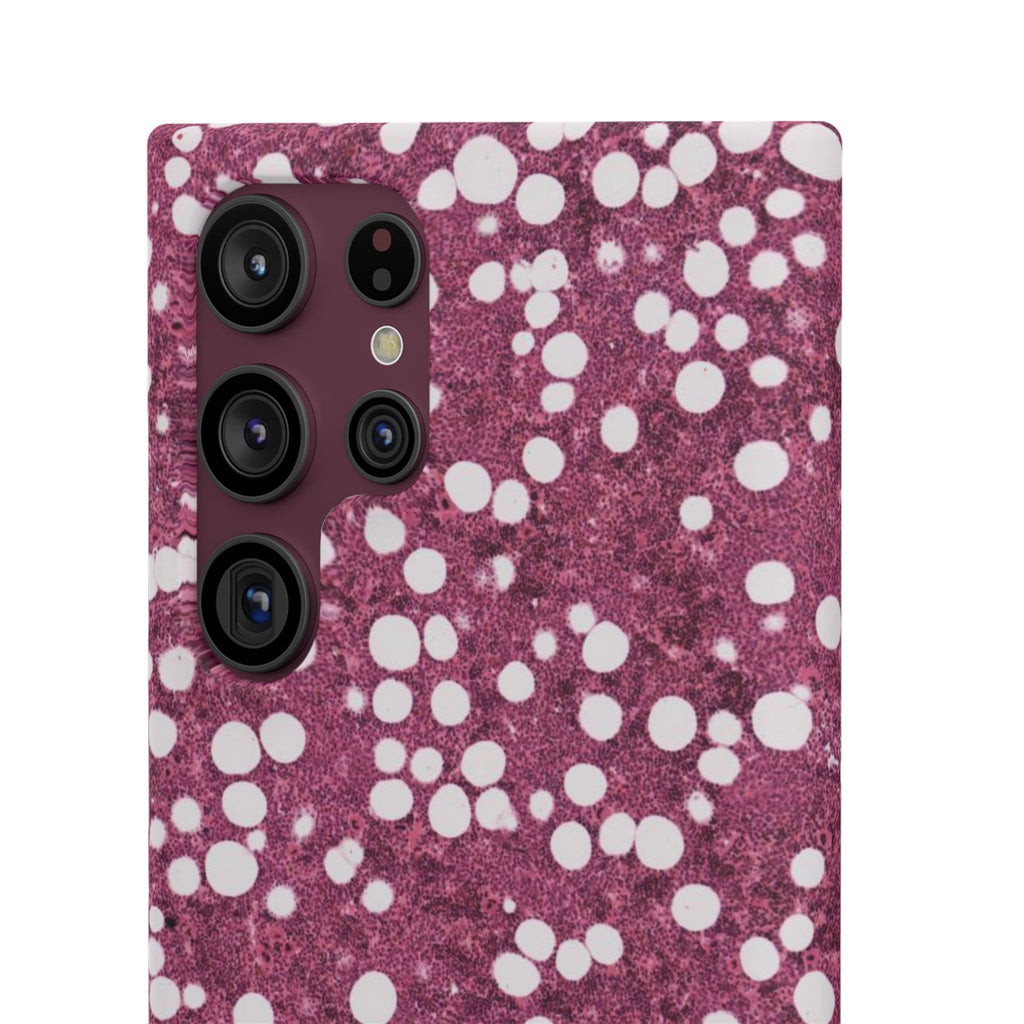Slim Case Myelolipom