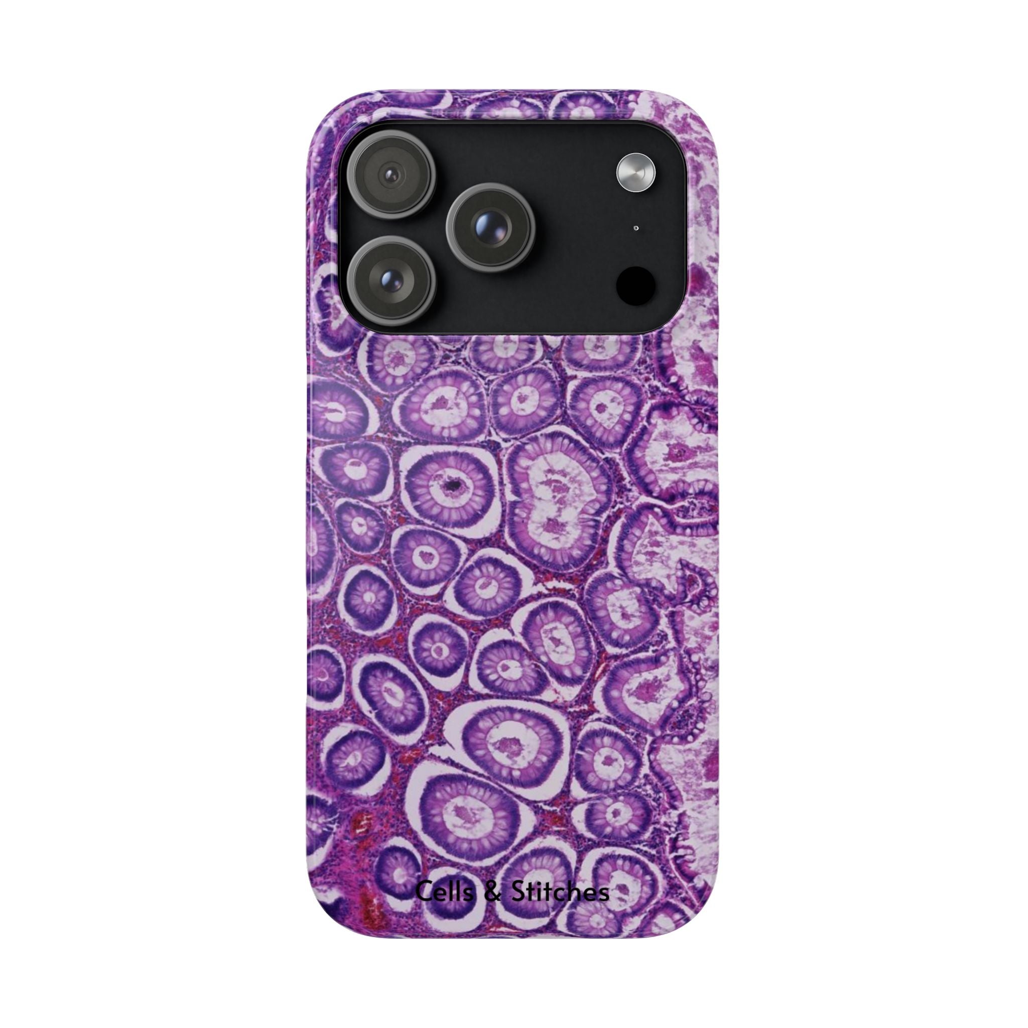 Slim Case Peutz-Jeghers Polyp