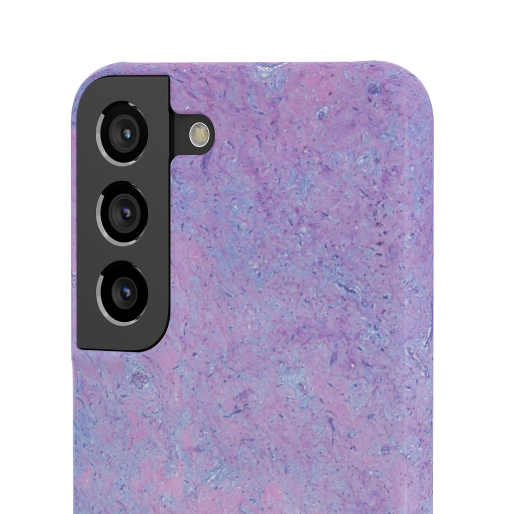 Slim Case Arterielles Myxom