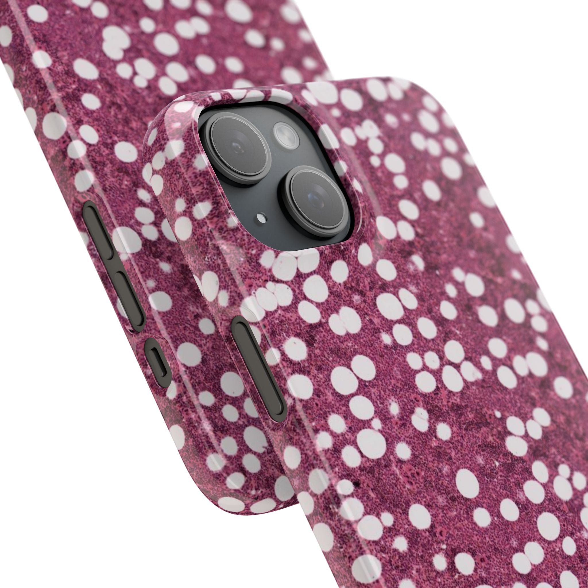 Slim Case Myelolipom