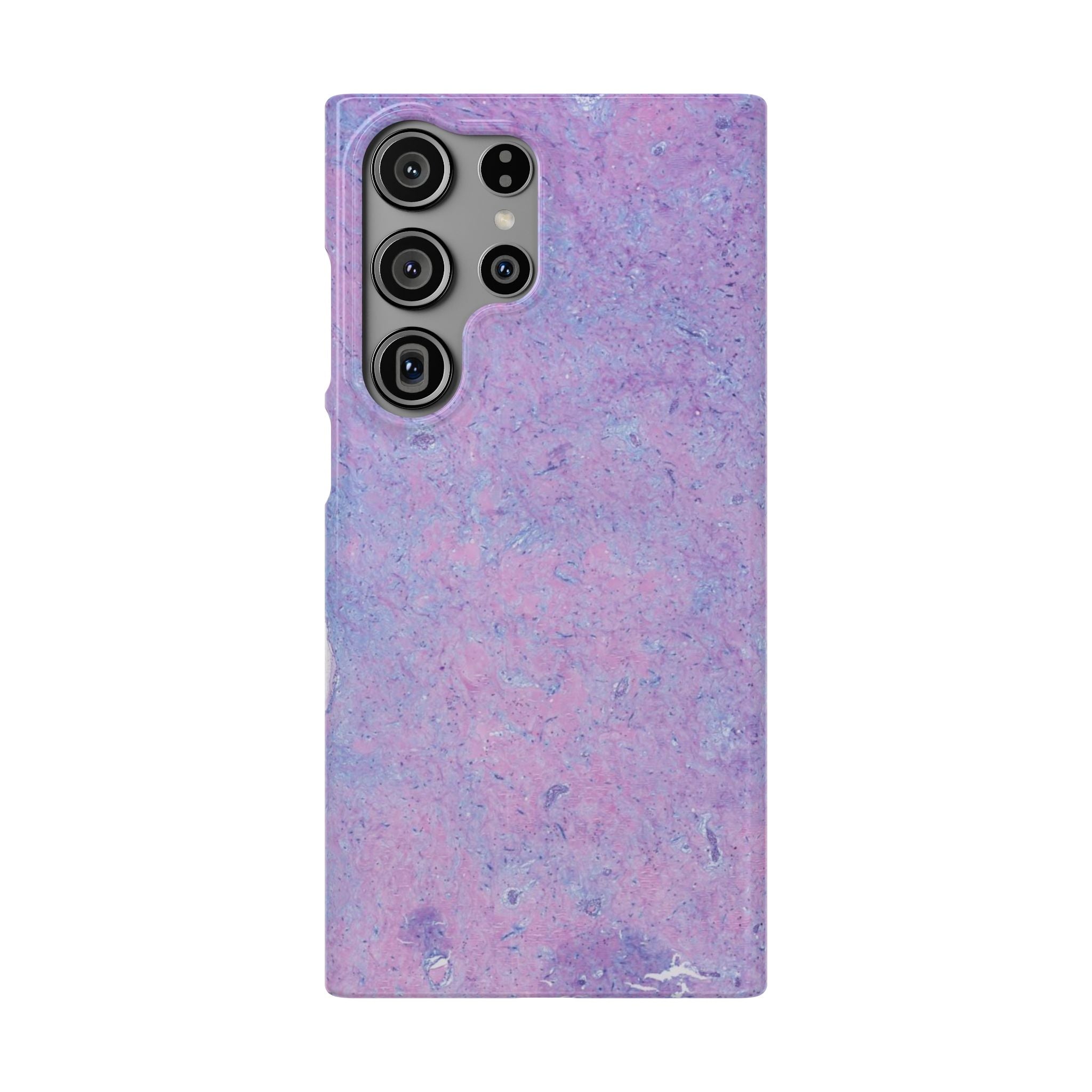 Slim Case Arterielles Myxom