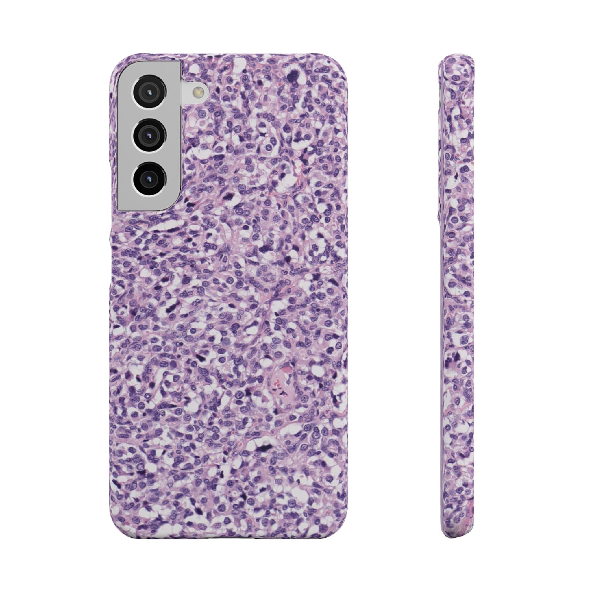 Slim Case Paraganglion