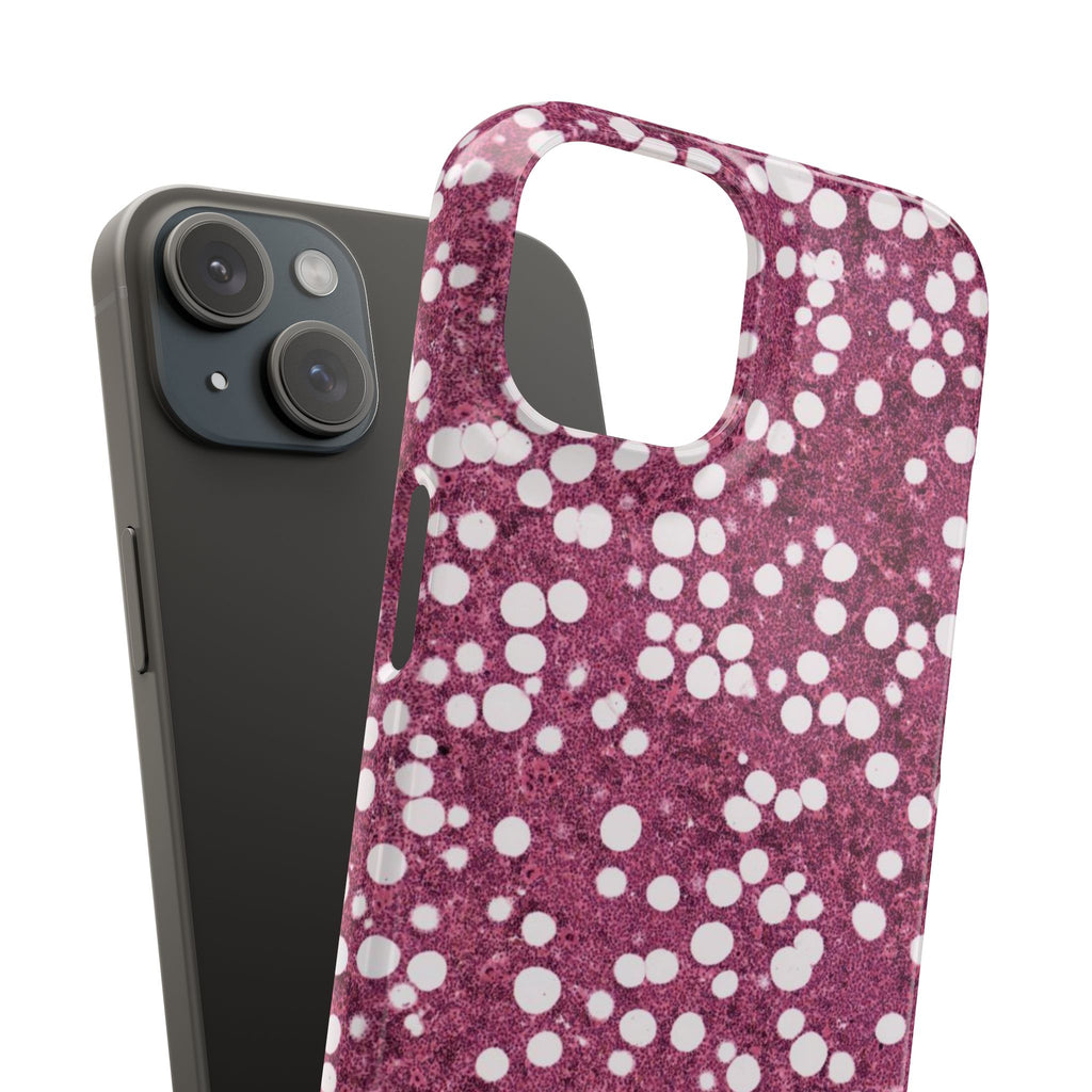 Slim Case Myelolipom